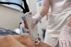 Лазерная эпиляция и удаление пигментации на аппарате Clarity II